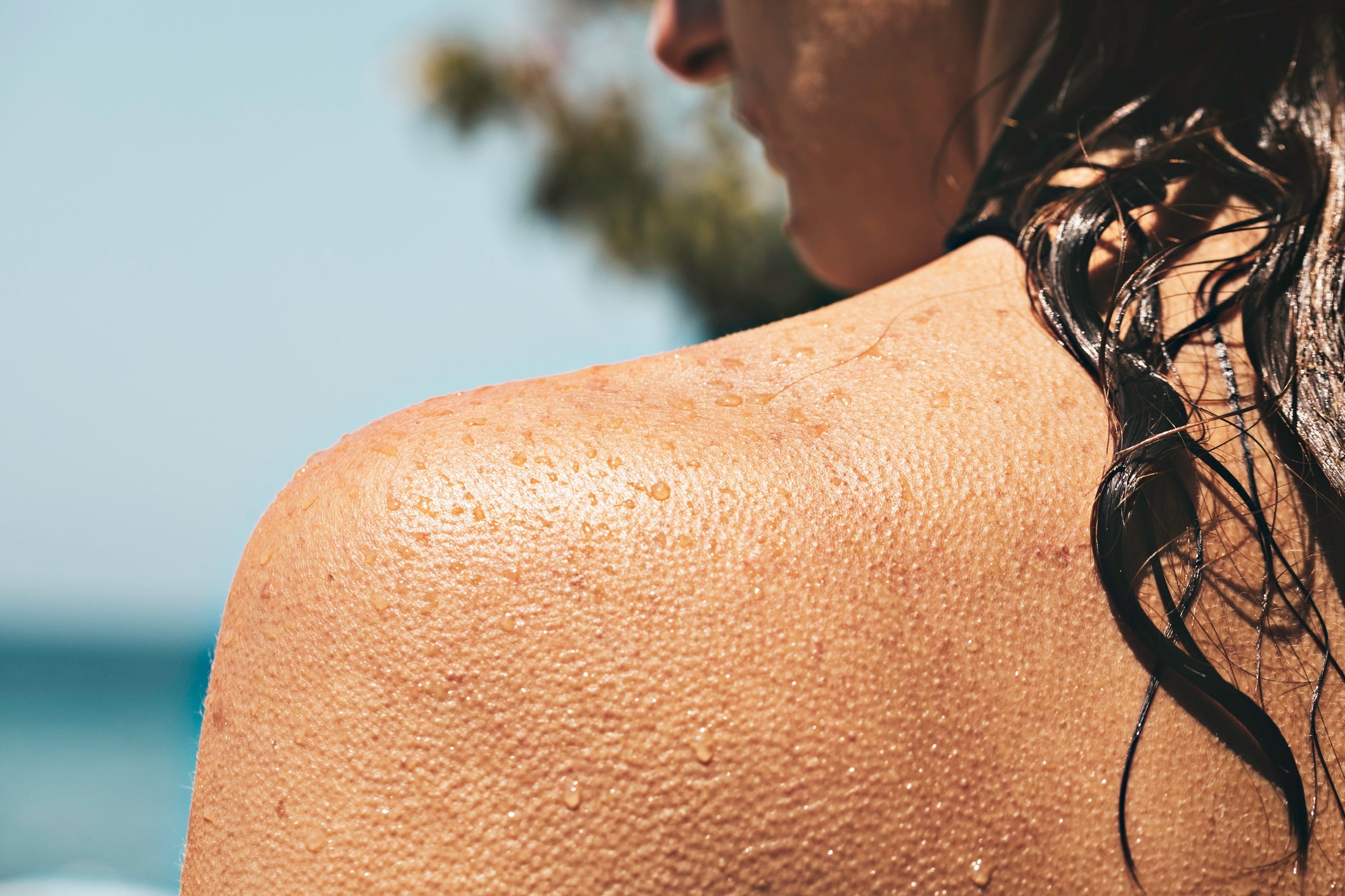 Managing Sun Damage and Hyperpigmentation Post-Summer