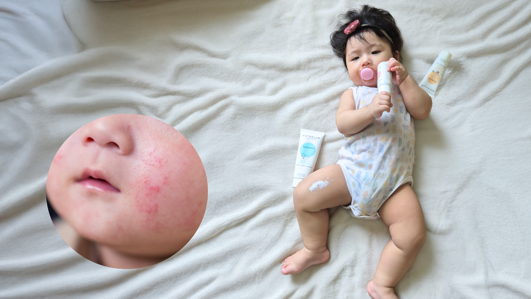 eczema for babies