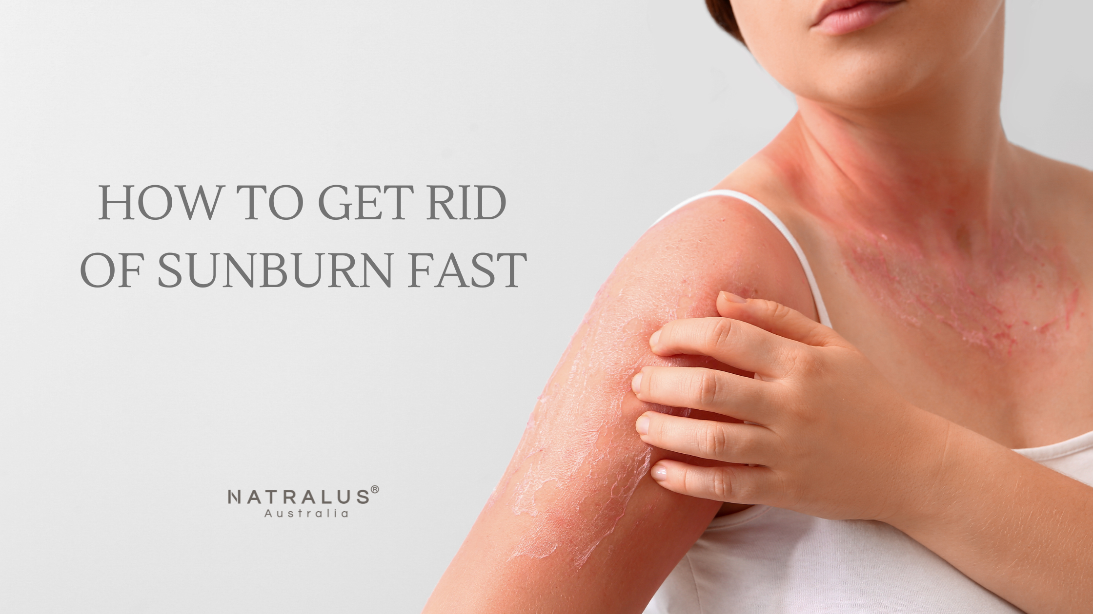 How to get rid of sunburn fast