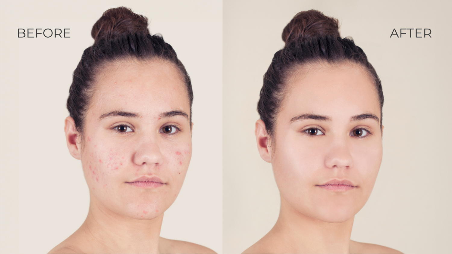 Beat acne for good with these natural solutions