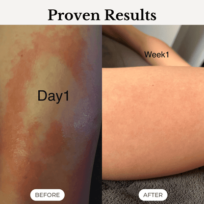 SorboDerm Natural Restoring Gentle Moisturiser for eczema and psoriasis