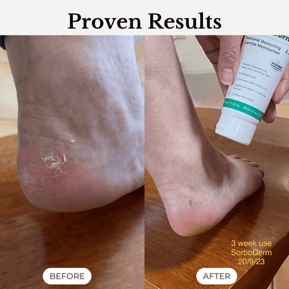 SorboDerm Natural Restoring Gentle Moisturiser for eczema and psoriasis